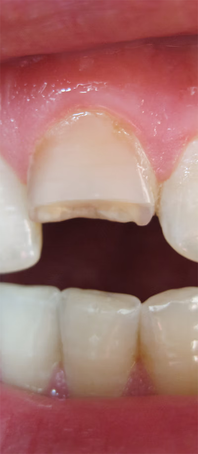 Close-up of chipped upper front tooth with some signs of infection.