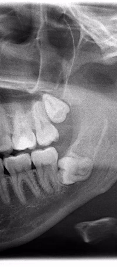 Dental X-ray showing a lower jaw with developing and impacted wisdom teeth.