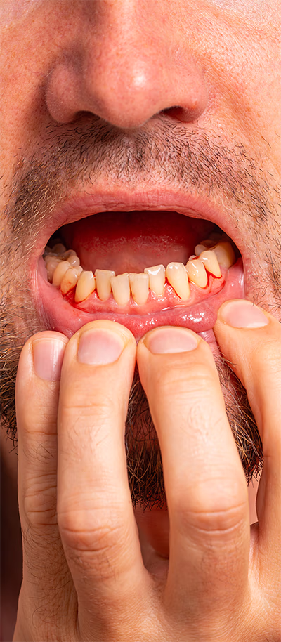 Close-up of a man's lower teeth and gums showing bleeding and inflammation.