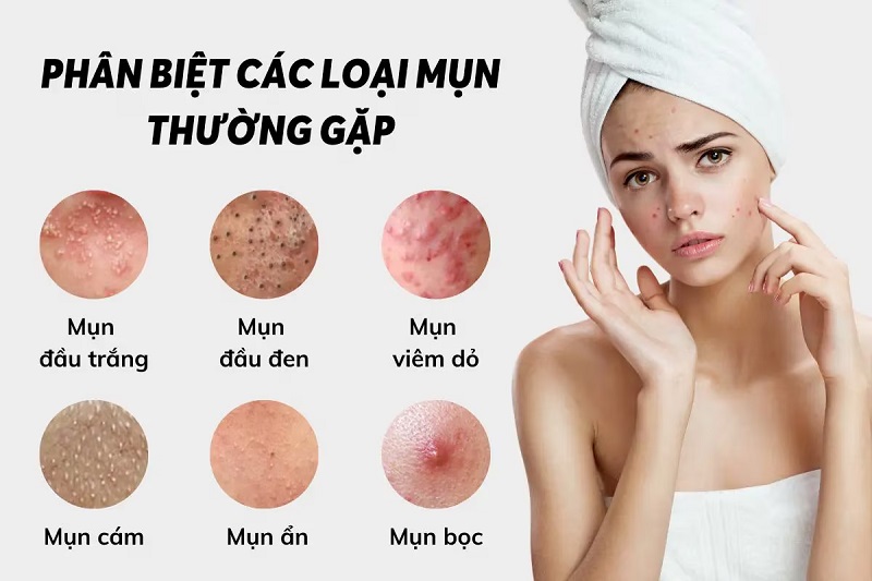 Phân Biệt Các Loại Mụn Và Cách Điều Trị Hiệu Quả - Jean d'Arcel Việt Nam