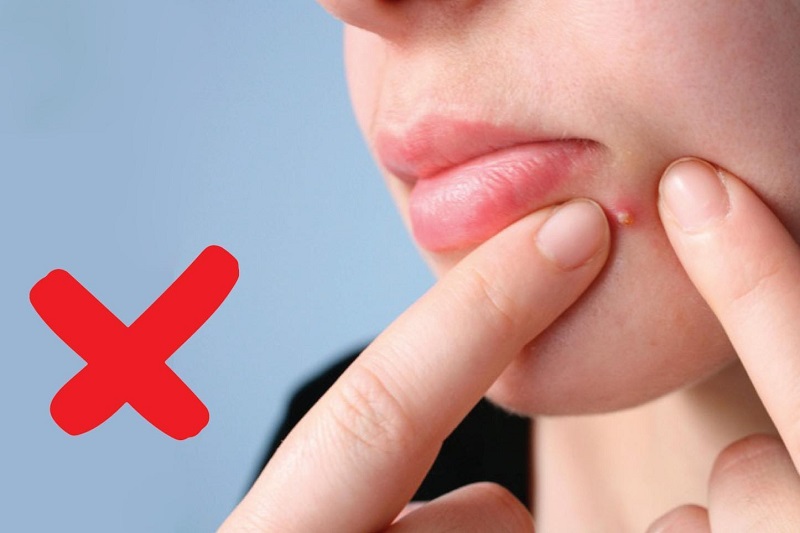 Hướng dẫn nặn mụn đúng cách để quên nỗi lo về sẹo