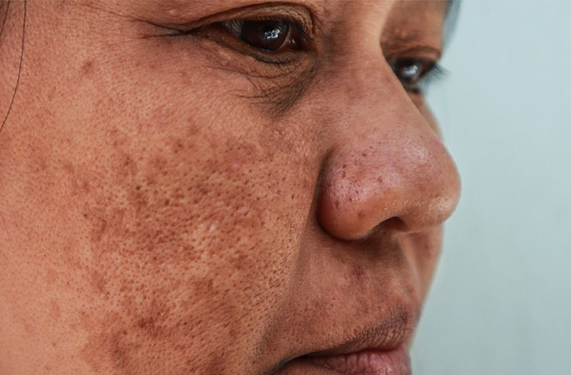 Nám da có phải dấu hiệu của lão hóa sớm? - Spotlite Official Website