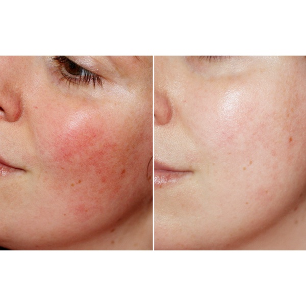 NGUYÊN TẮC VÀNG PHỤC HỒI SIÊU TỐC SAU TREATMENT – La Bonita Chính Hãng