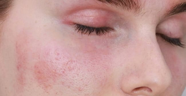 Da Nhạy Cảm Là Gì? Dấu Hiệu Nhận Biết Và Cách Chăm Sóc | Eucerin