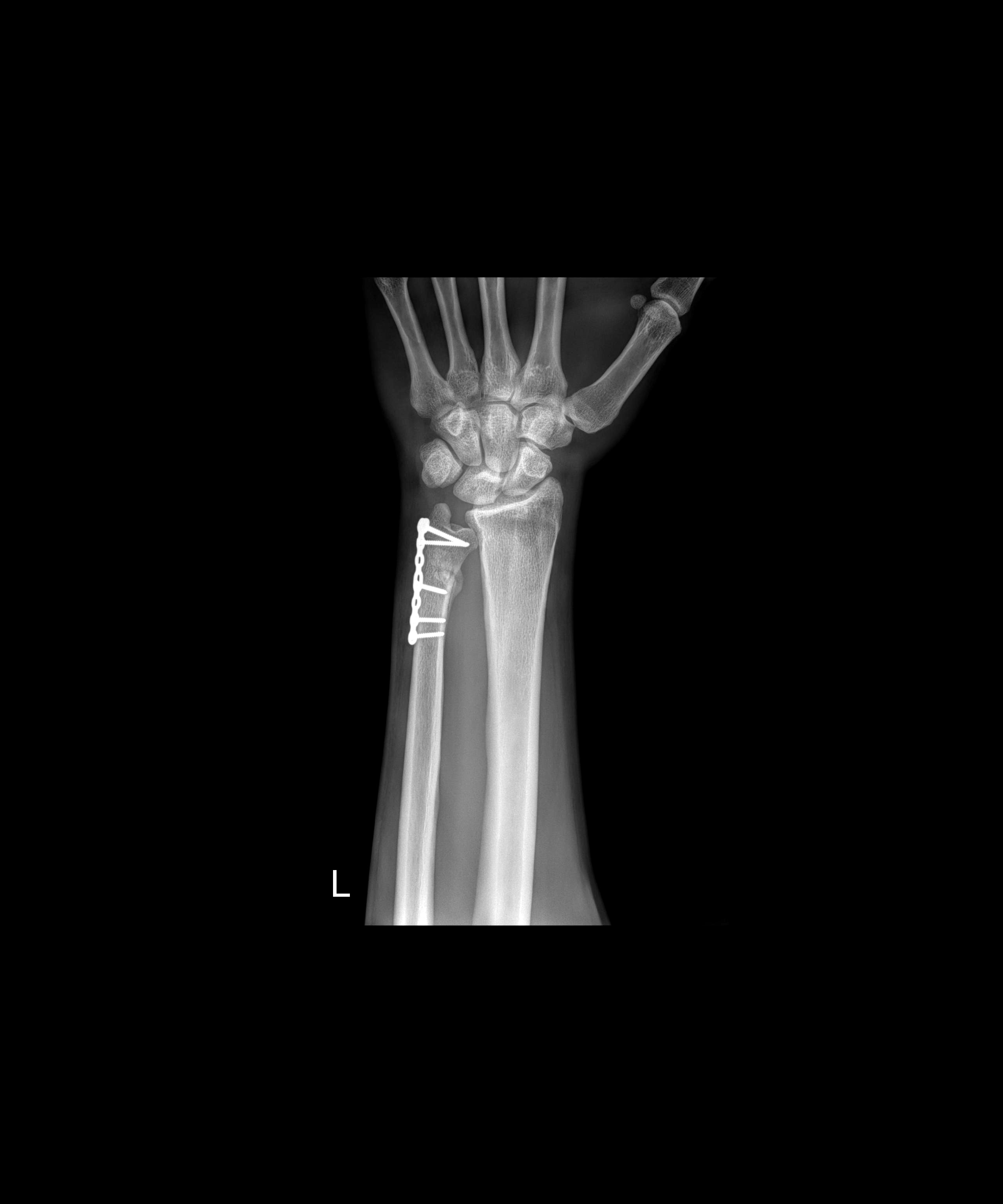 X-ray showing surgical plate and screws used to repair left wrist fracture following motorcycle racing crash