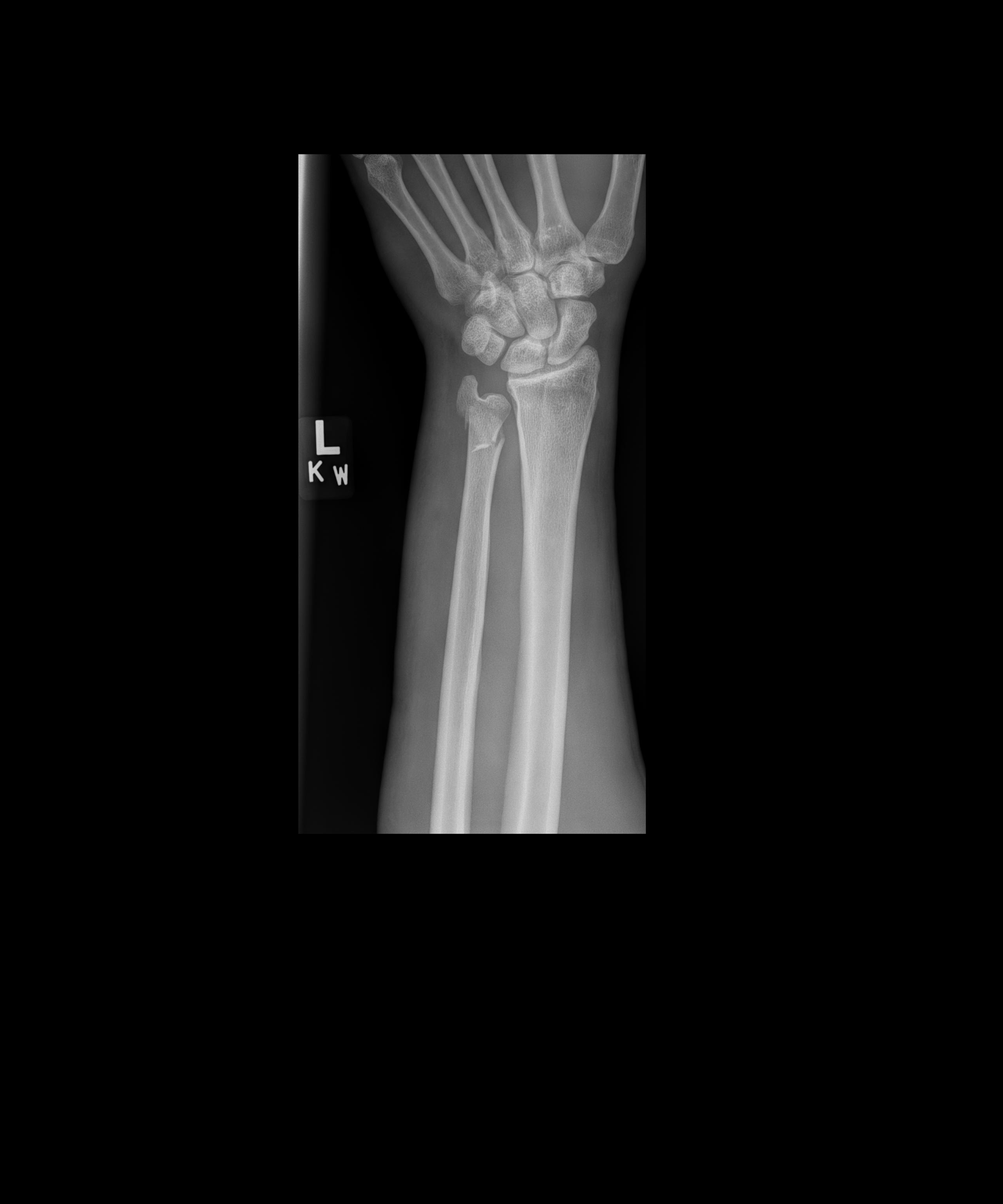 X-ray showing left wrist fracture sustained in motorcycle racing crash at High Plains Raceway Colorado