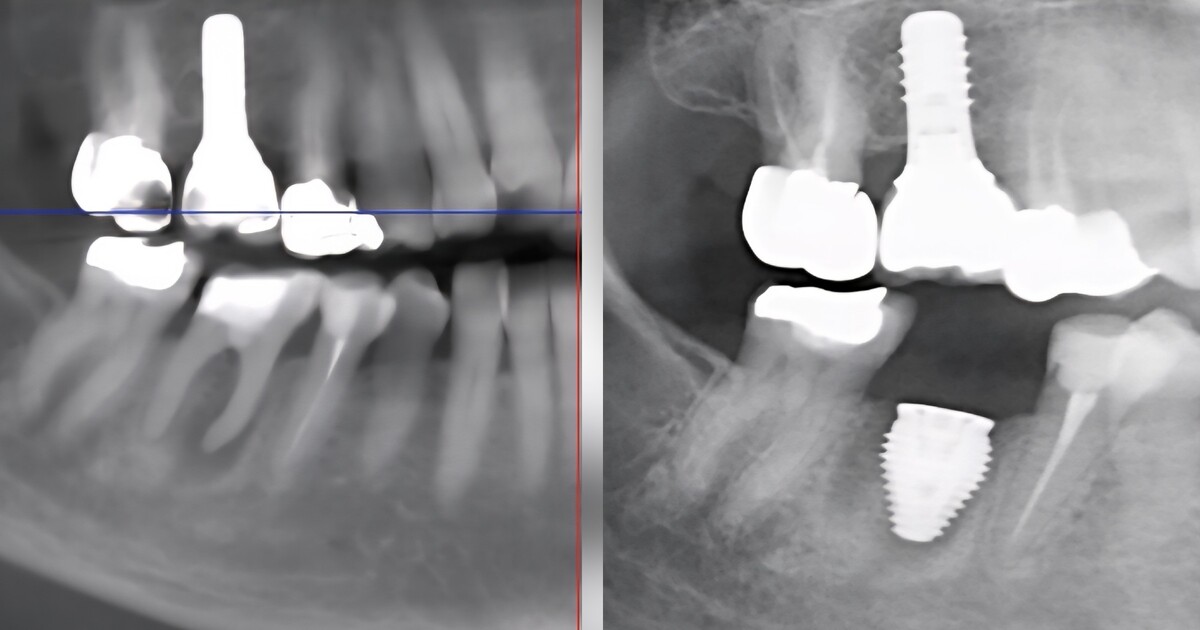 orthèse d'avancée m'mandibulaire pour l'apnée du sommeil