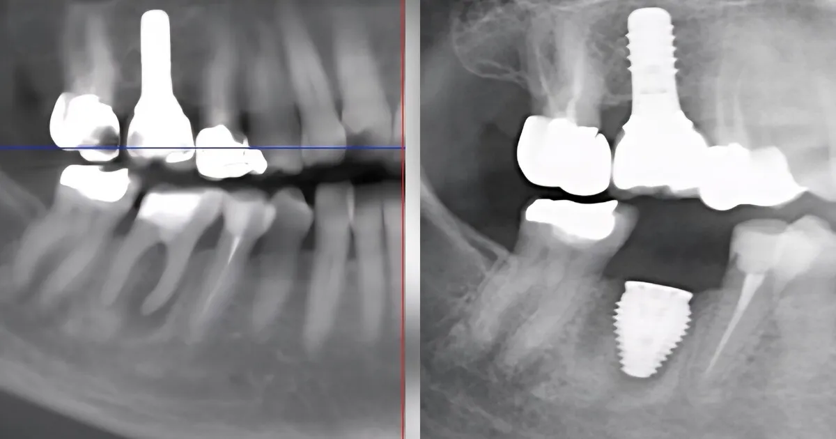 Radiographie dentaire montrant plusieurs implants et couronnes dentaires sur les molaires inférieures, un avant après, extraction-implantation-immédiate