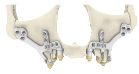 Représentation 3D d’un maxillaire supérieur avec deux implants sous-périostés fixés sur les os maxillaires.