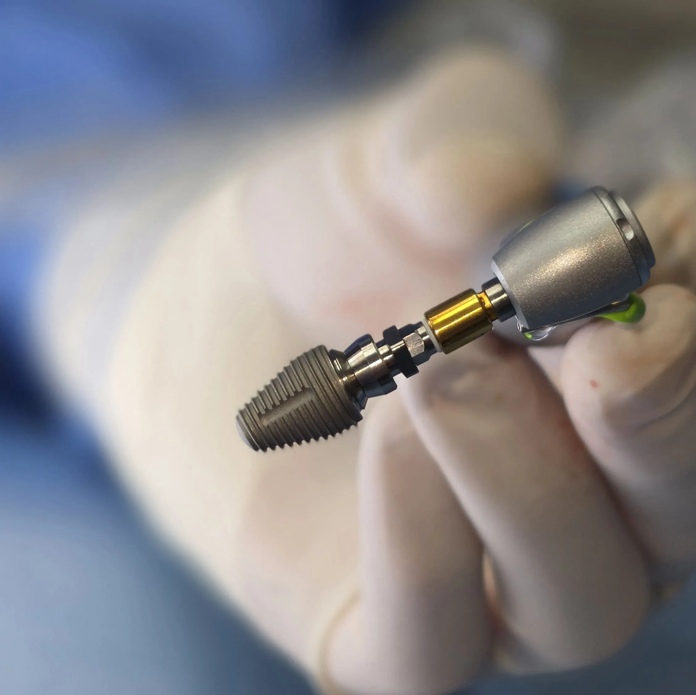 Extraction implantation immédiate avec un implant MAX de Southern Implants