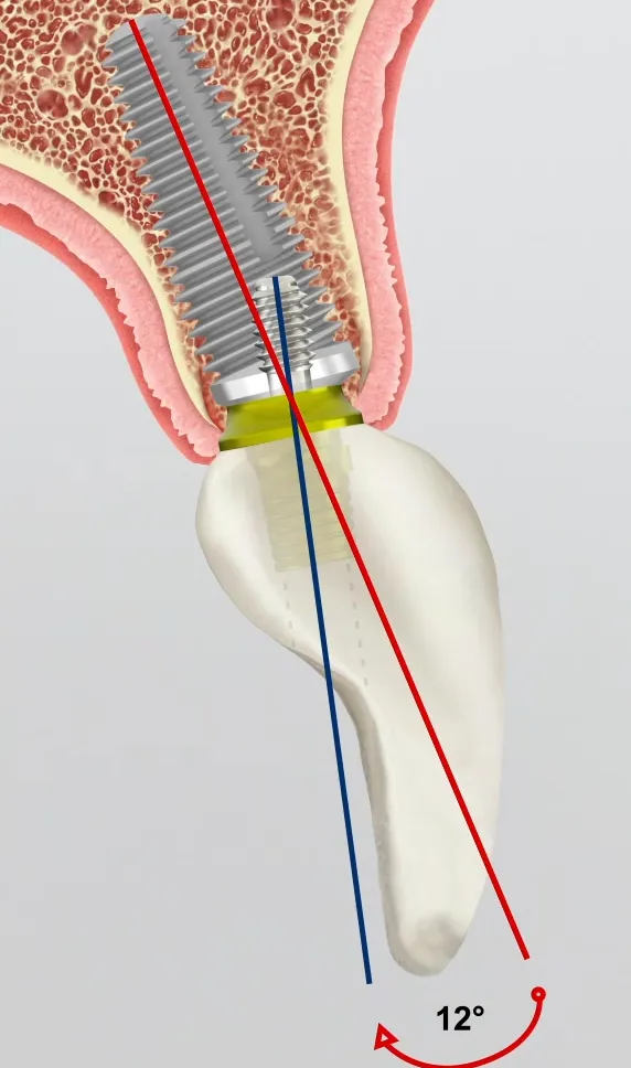implant coaxis rattrapage axial intégré dans le corps de l'implant