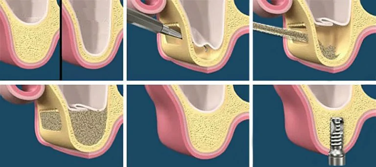 Schéma en six étapes d'une intervention de sinus lift pour implantation dentaire.