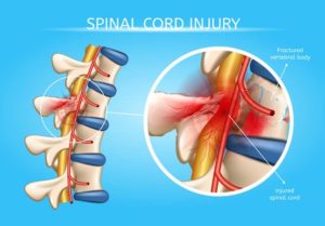 Learn about common symptoms and treatments for spinal cord injuries. Find out steps you can take to help prevent a spinal cord injury.