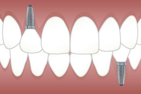 dental implants uses