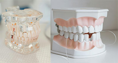 Implants vs dentures