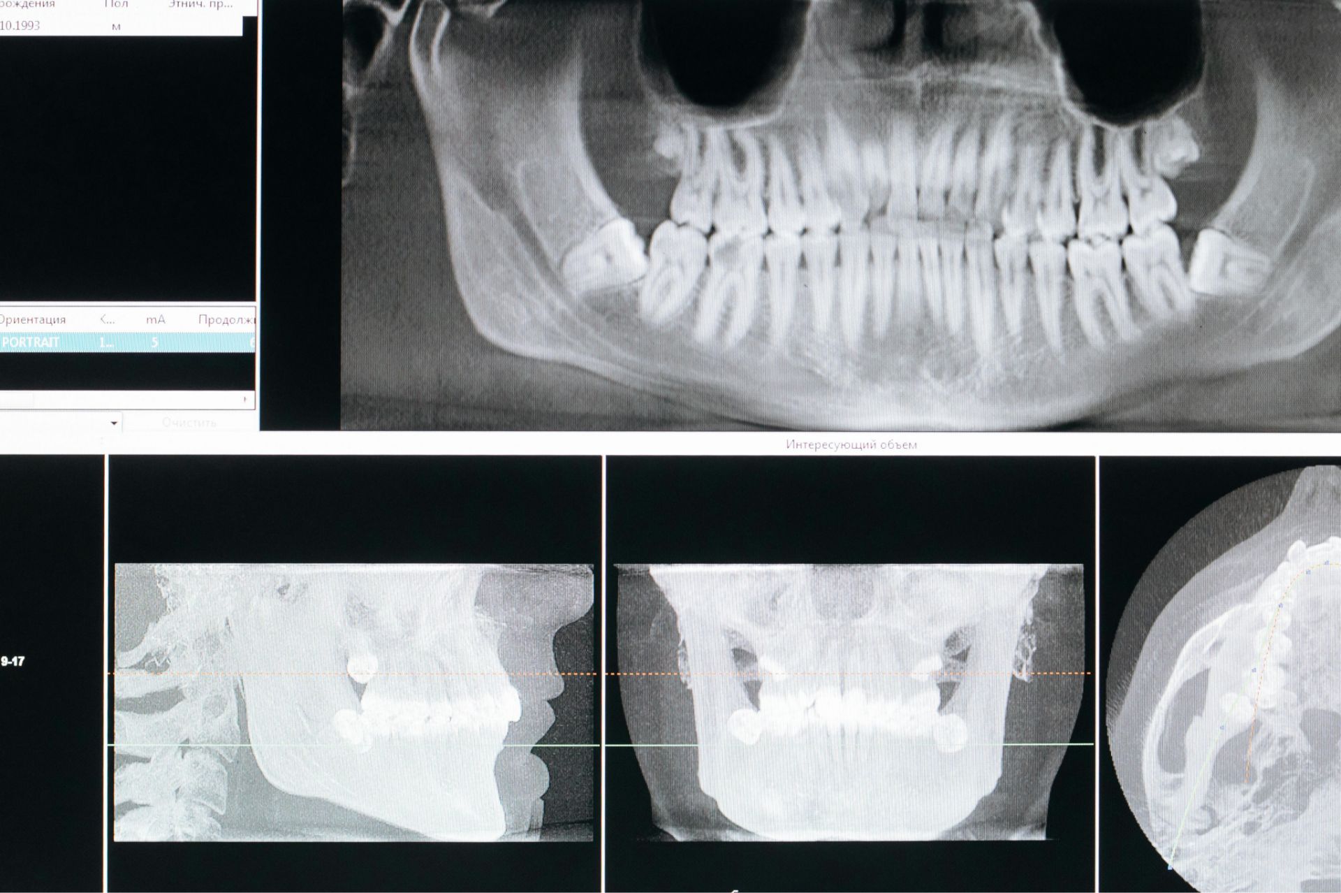 Dental X-ray images showing panoramic, lateral, and frontal views of teeth and jawbone, including impacted wisdom teeth.