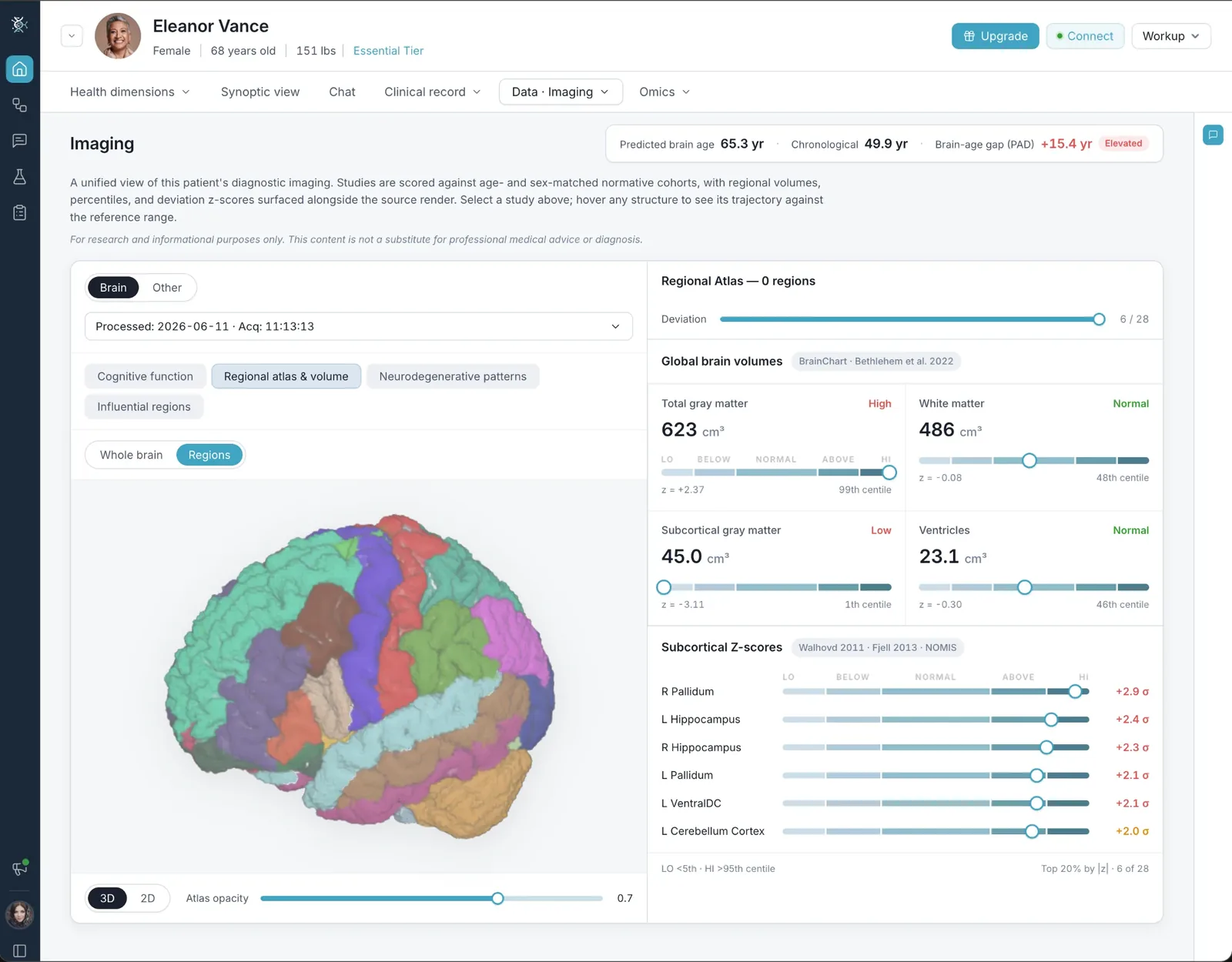 Imaging view with a segmented 3D brain, global brain volumes and subcortical z-scores
