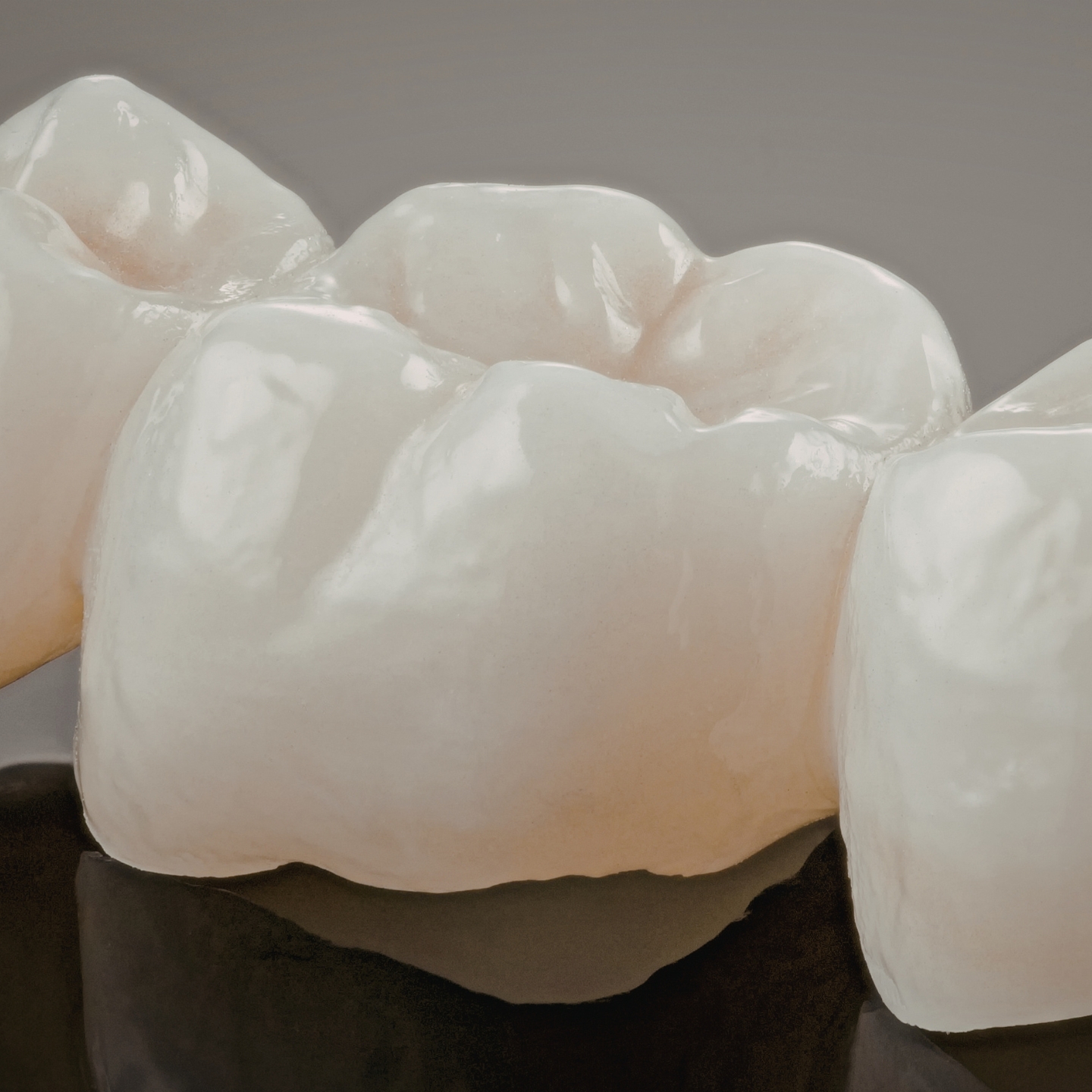 A close-up view of ceramic dental crowns seated on teeth, showing natural contours and smooth surfaces.
