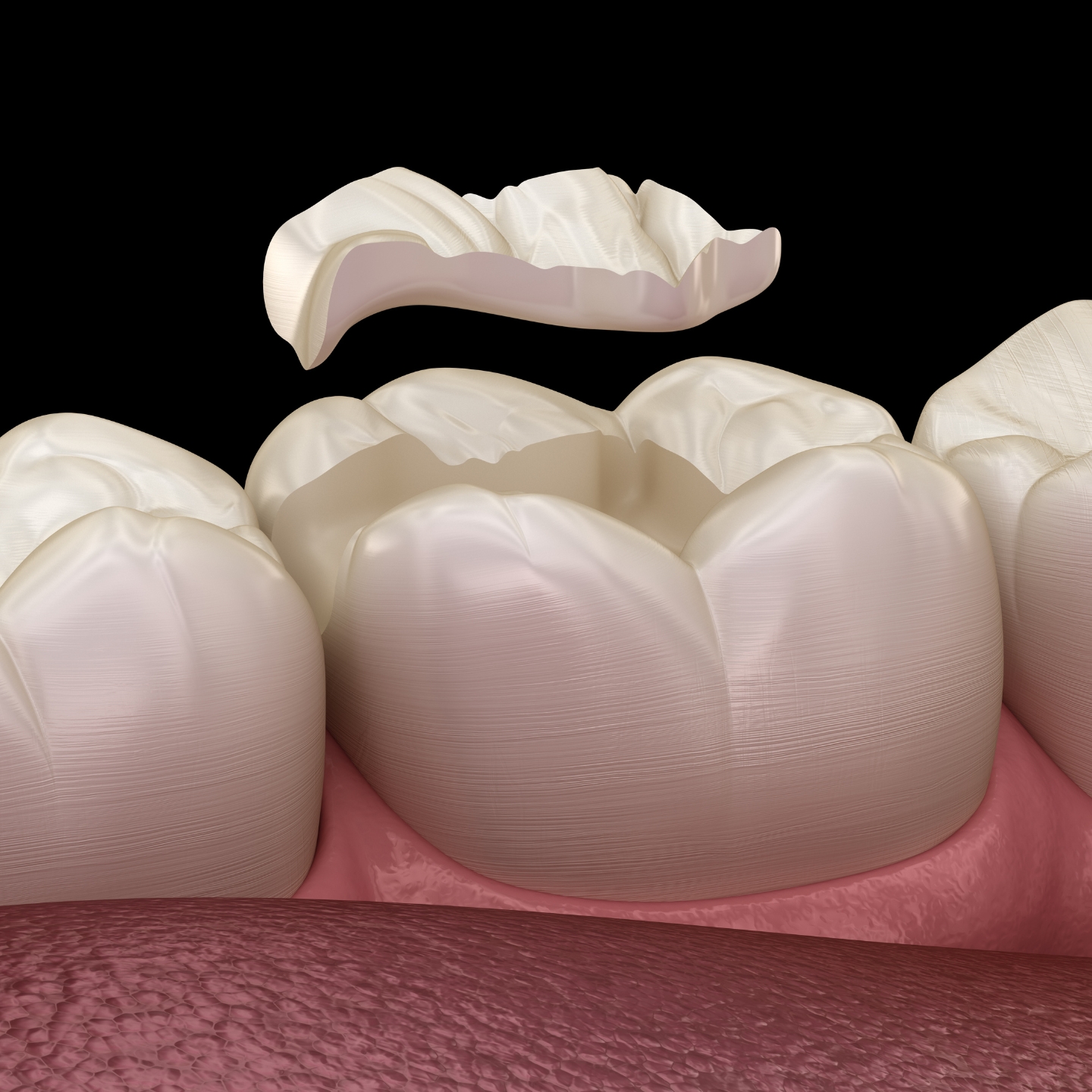 A dental illustration shows a filling restoration placed into a prepared tooth cavity, restoring its shape and structure.