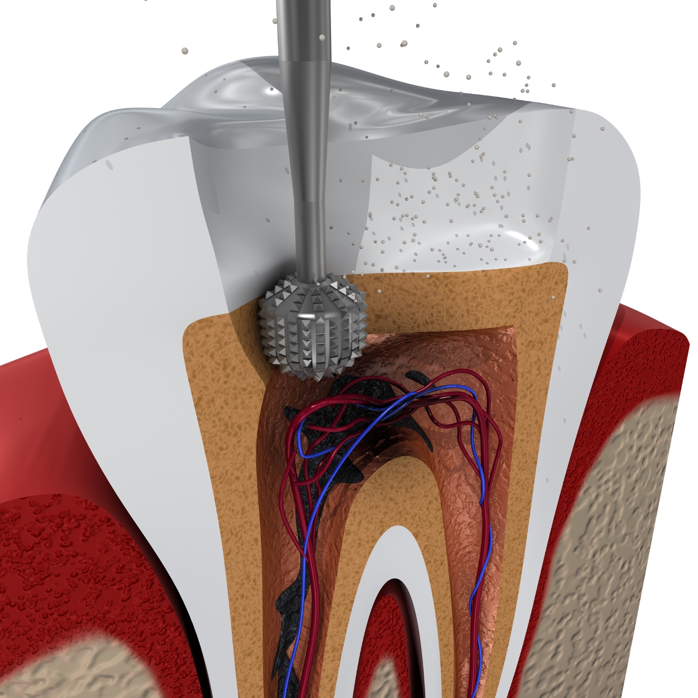 A detailed illustration shows a root canal procedure removing infected tissue from inside a tooth using a dental instrument.