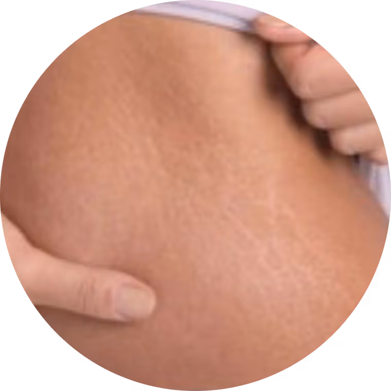 Nahaufnahme von Bauchhaut mit sichtbaren Dehnungsstreifen und zwei Händen, die das Gewebe leicht anheben.