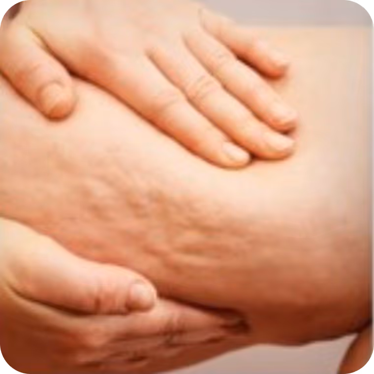 Nahaufnahme einer Hand, die auf Haut mit sichtbarer Cellulite gedrückt wird.