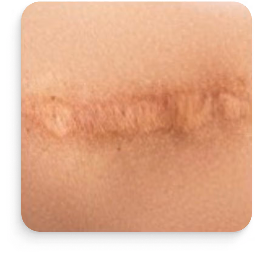 Nahaufnahme einer erhabenen, rosafarbenen Narbe auf heller Haut.