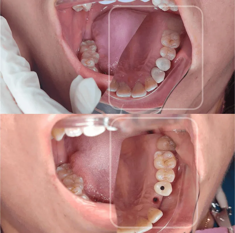 Before and after patient undergoes dental implant and crown, completing his smile.
