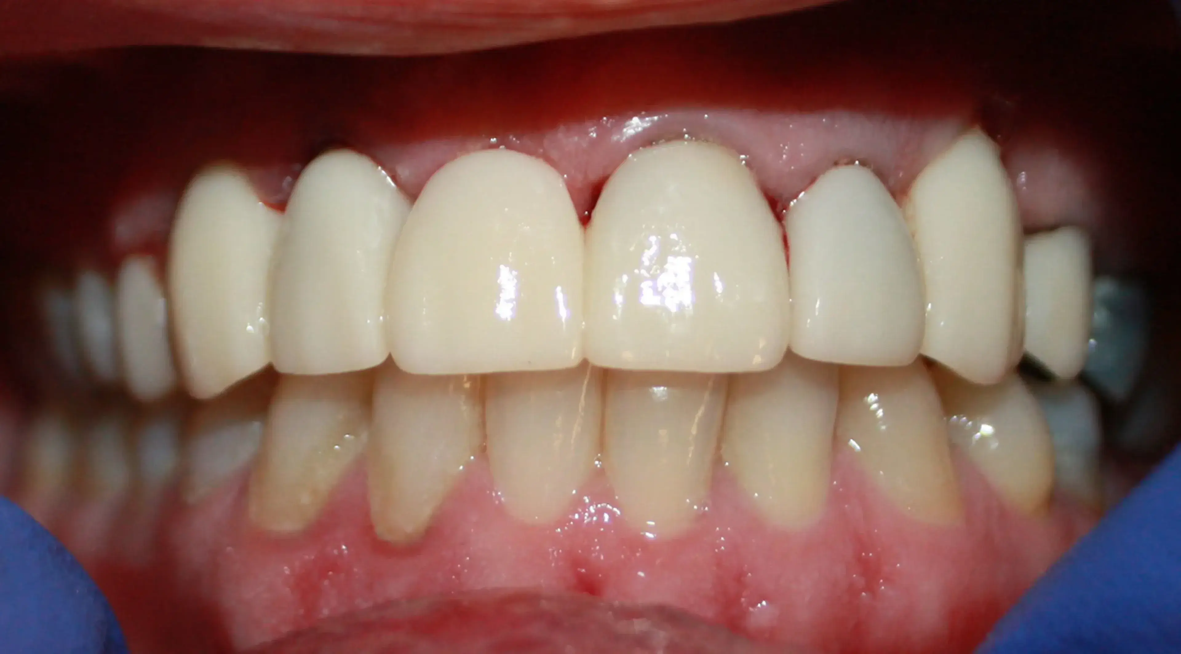 Close-up of upper and lower teeth showing dental crowns on the upper front teeth.