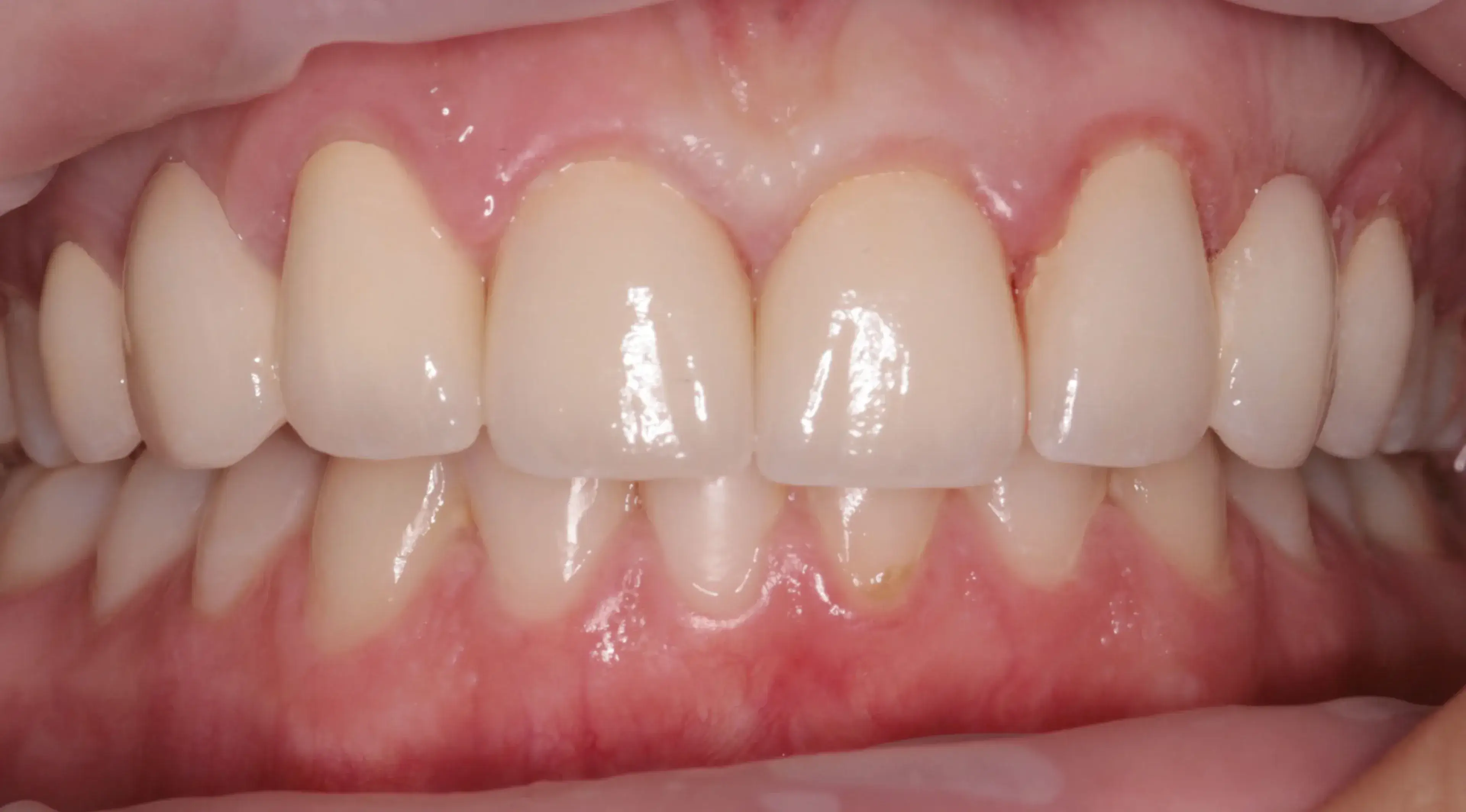 Close-up of upper and lower front teeth showing dental alignment and gums.