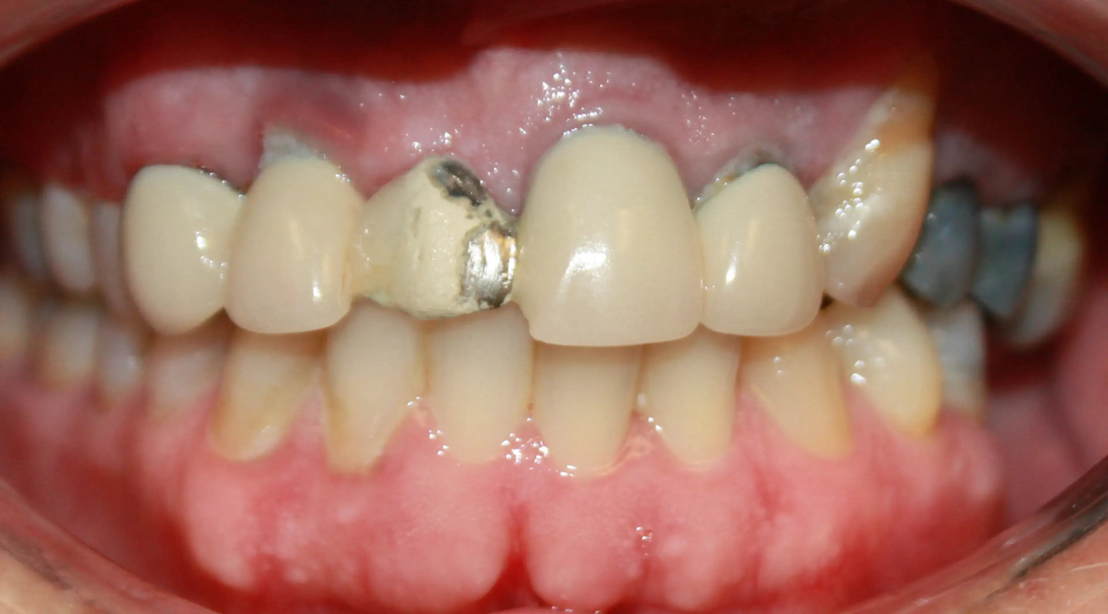 Close-up of upper front teeth showing dental crowns, with one crown showing discoloration and metal exposure.