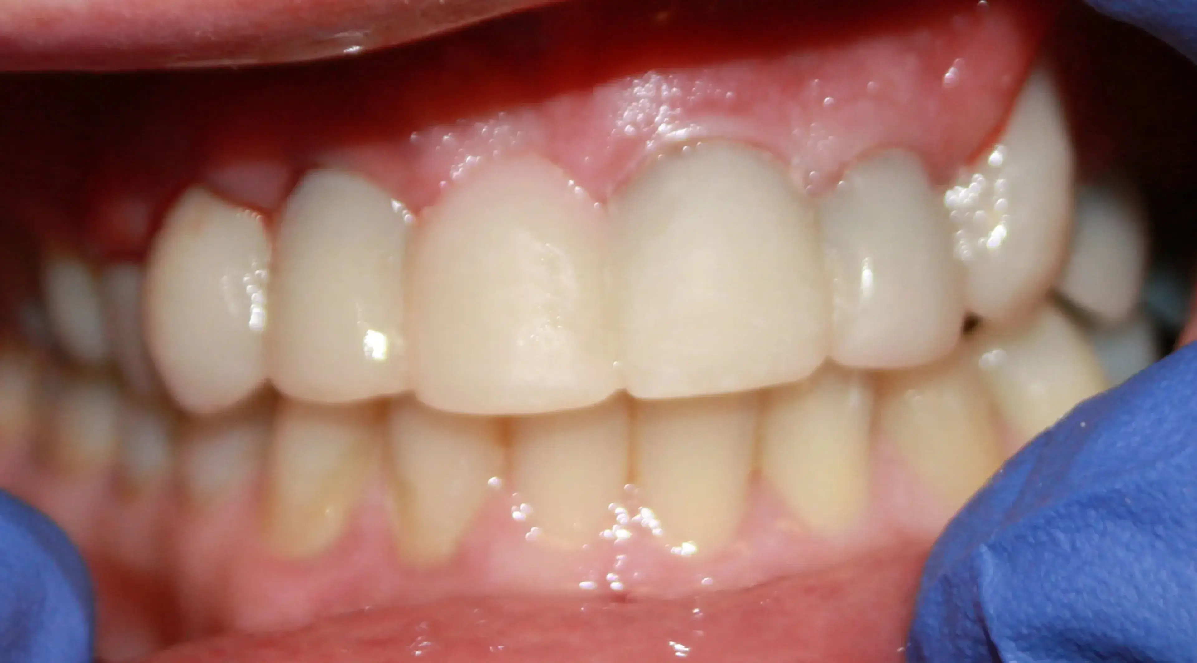 Close-up of a dental professional wearing blue gloves holding open a patient's mouth showing clean upper and lower teeth and gums.