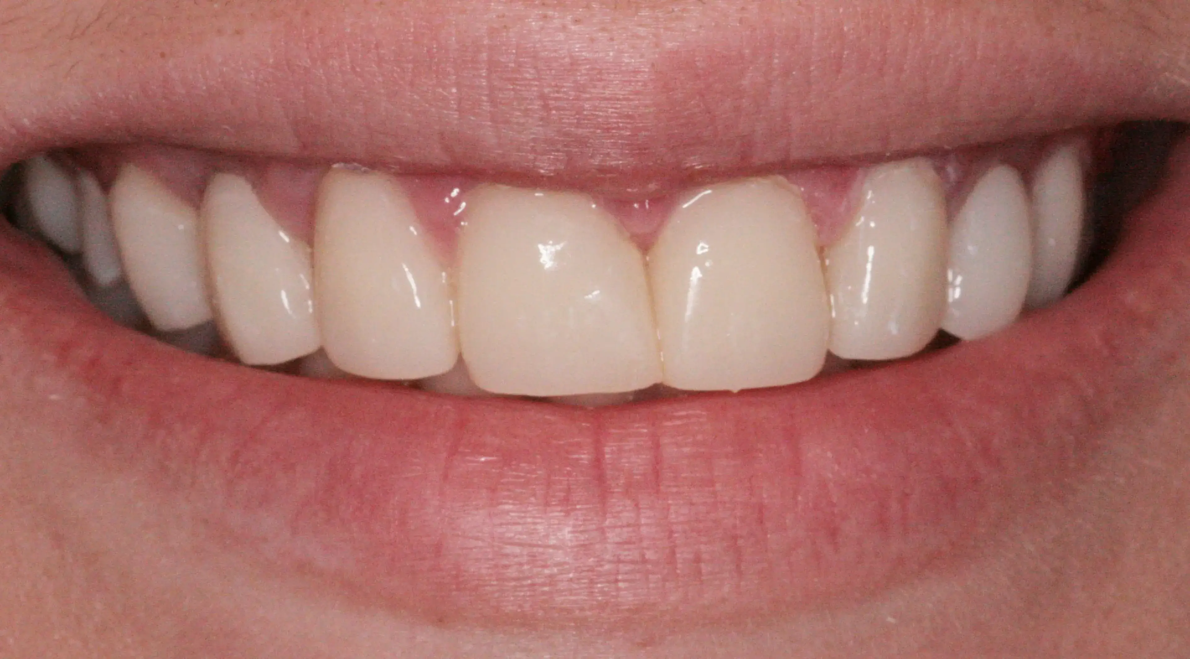 Close-up of a smiling mouth showing clean, well-aligned upper front teeth and natural lips.