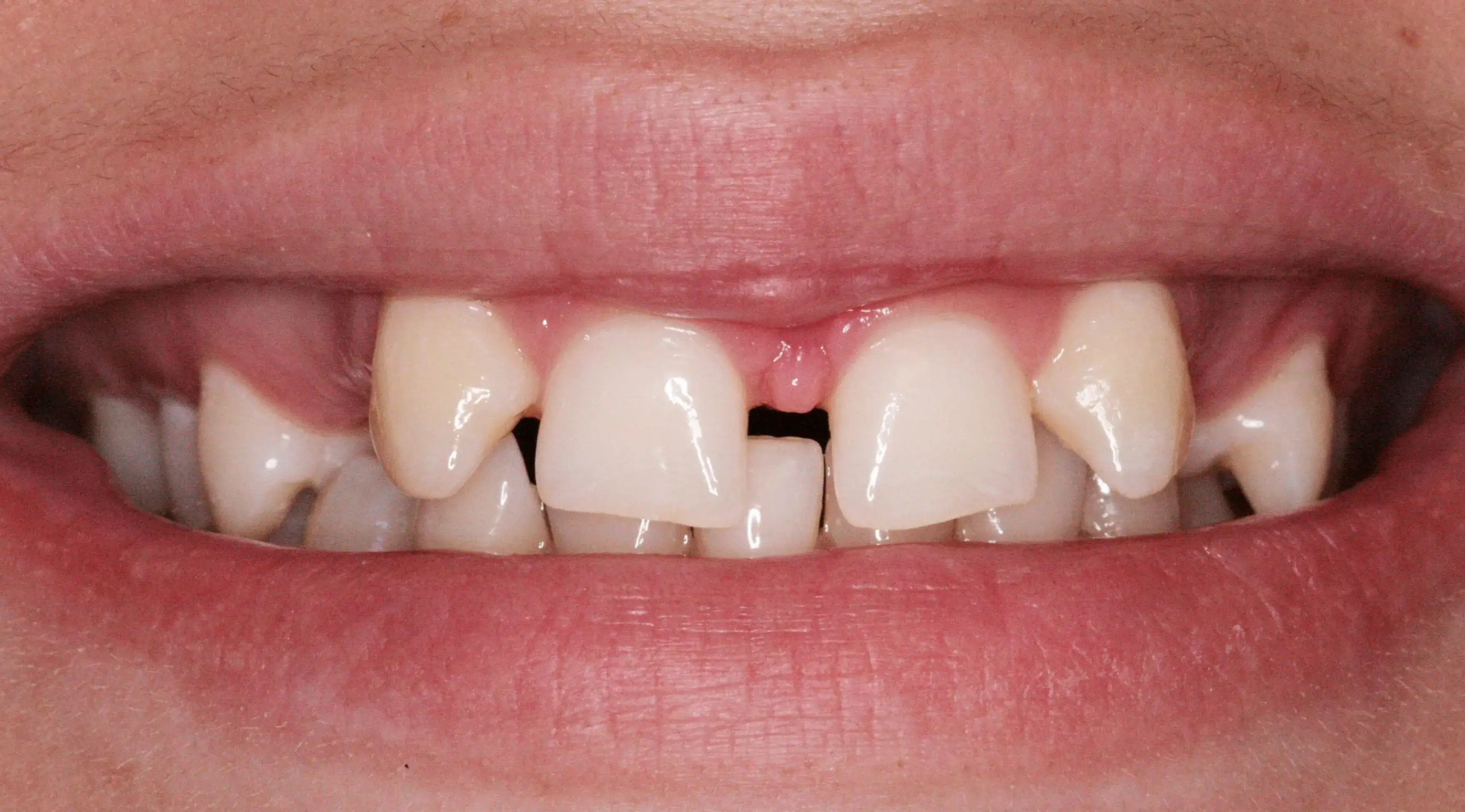 Close-up of a mouth showing slightly crooked upper front teeth and visible gums.