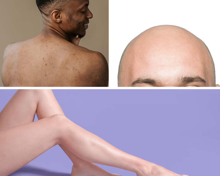 Collage with a smiling man showing his bare back, a close-up of a bald forehead, and a pair of smooth crossed legs against a purple background.
