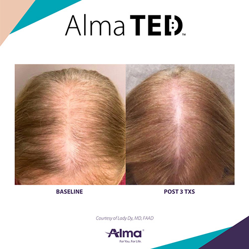 Side-by-side scalp photos showing hair improvement: left image labeled 'Baseline' with thinner hair, right image labeled 'Post 3 TXS' with denser hair.