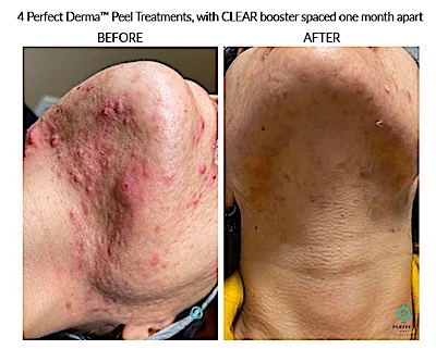 Comparison of a woman's scalp showing hair thinning at baseline and visibly thicker hair and coverage after two Alma TED treatments.