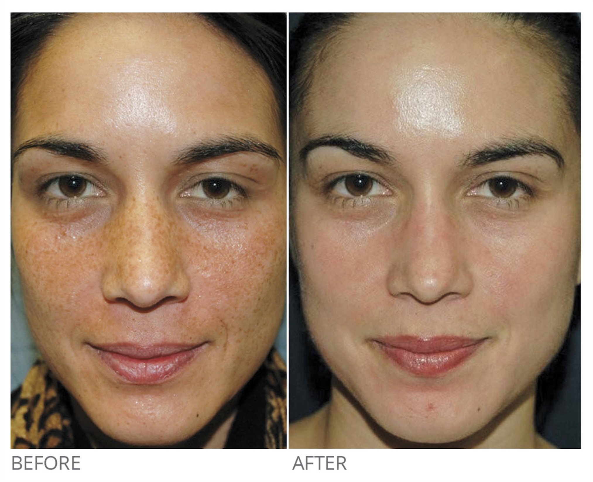 Side-by-side scalp photos showing hair improvement: left image labeled 'Baseline' with thinner hair, right image labeled 'Post 3 TXS' with denser hair.