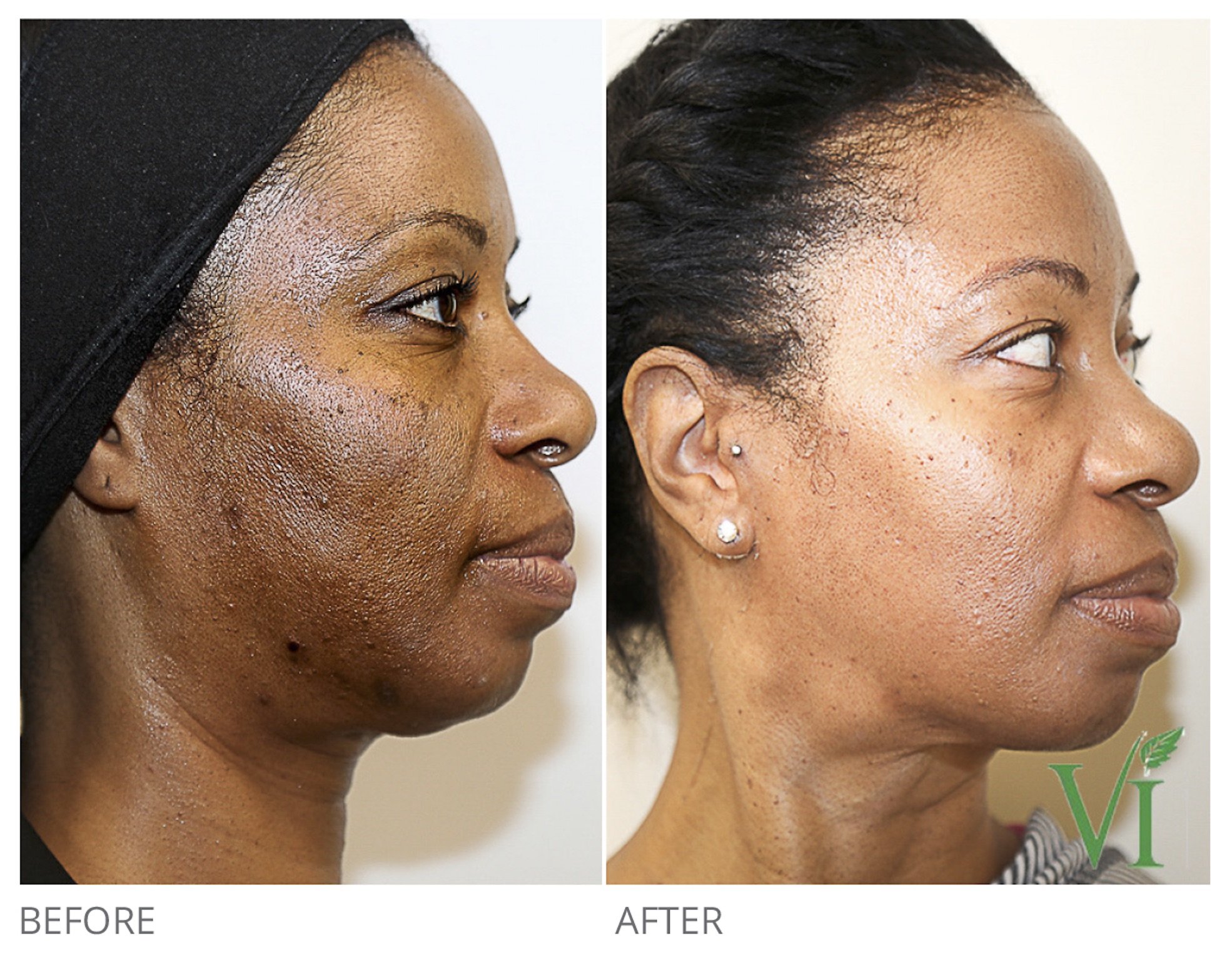 Side-by-side images showing a woman’s hair part before and after treatment, with noticeably thicker hair in the post-treatment photo.