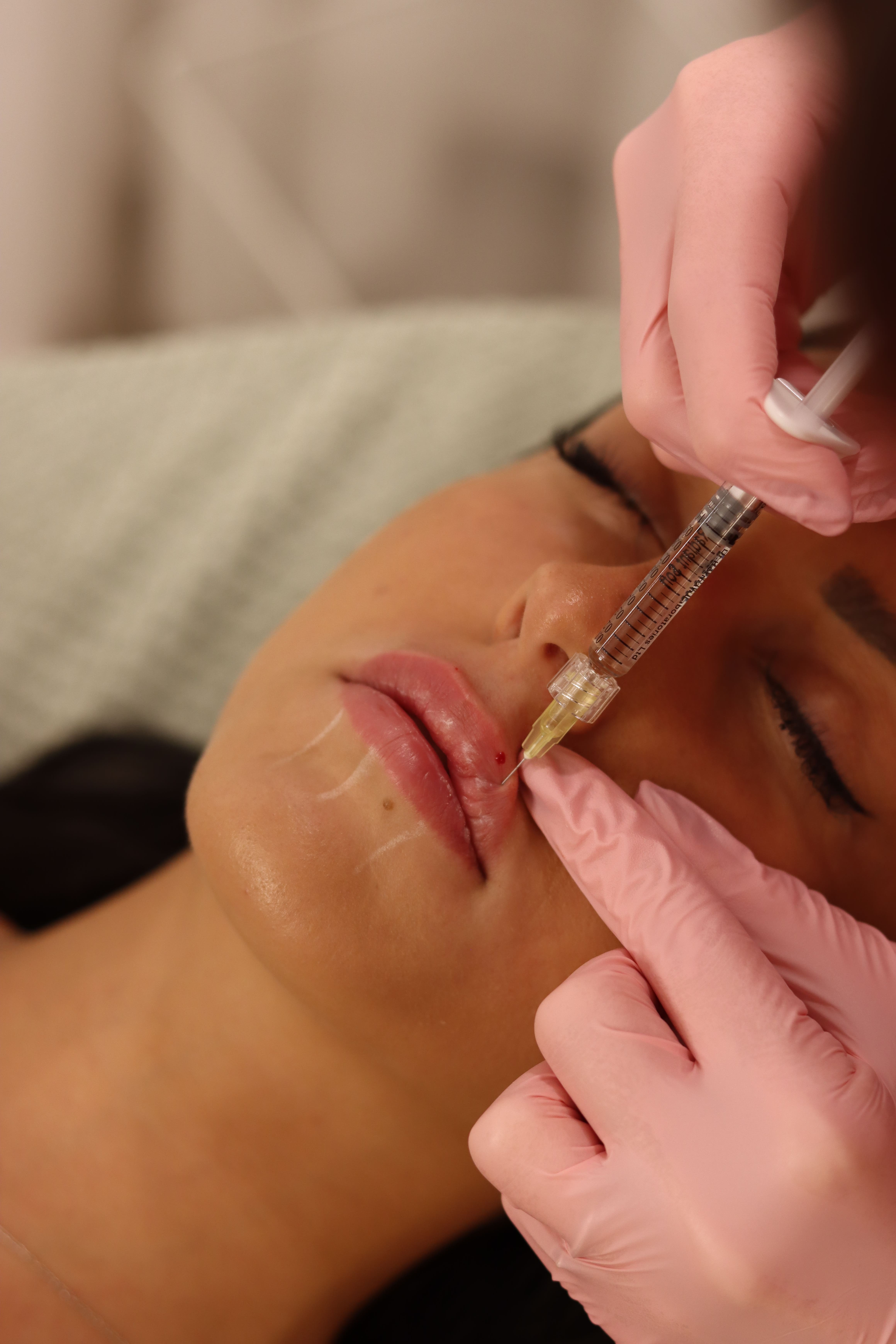Hyaluronic fillers