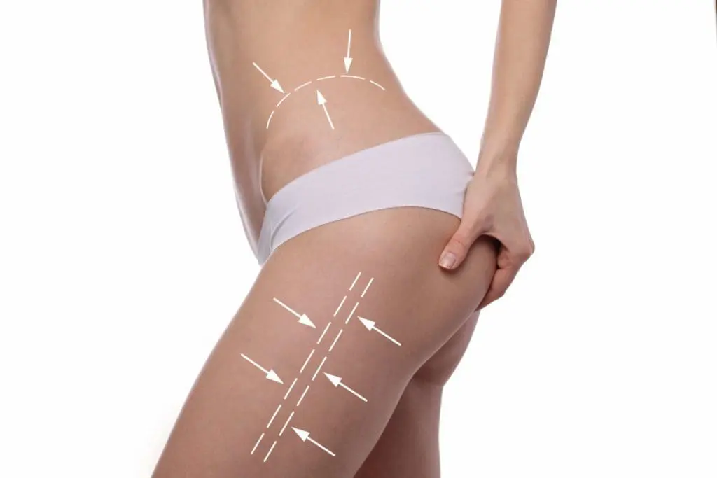 Flank lipolysis treatment Dermiere Aesthetic