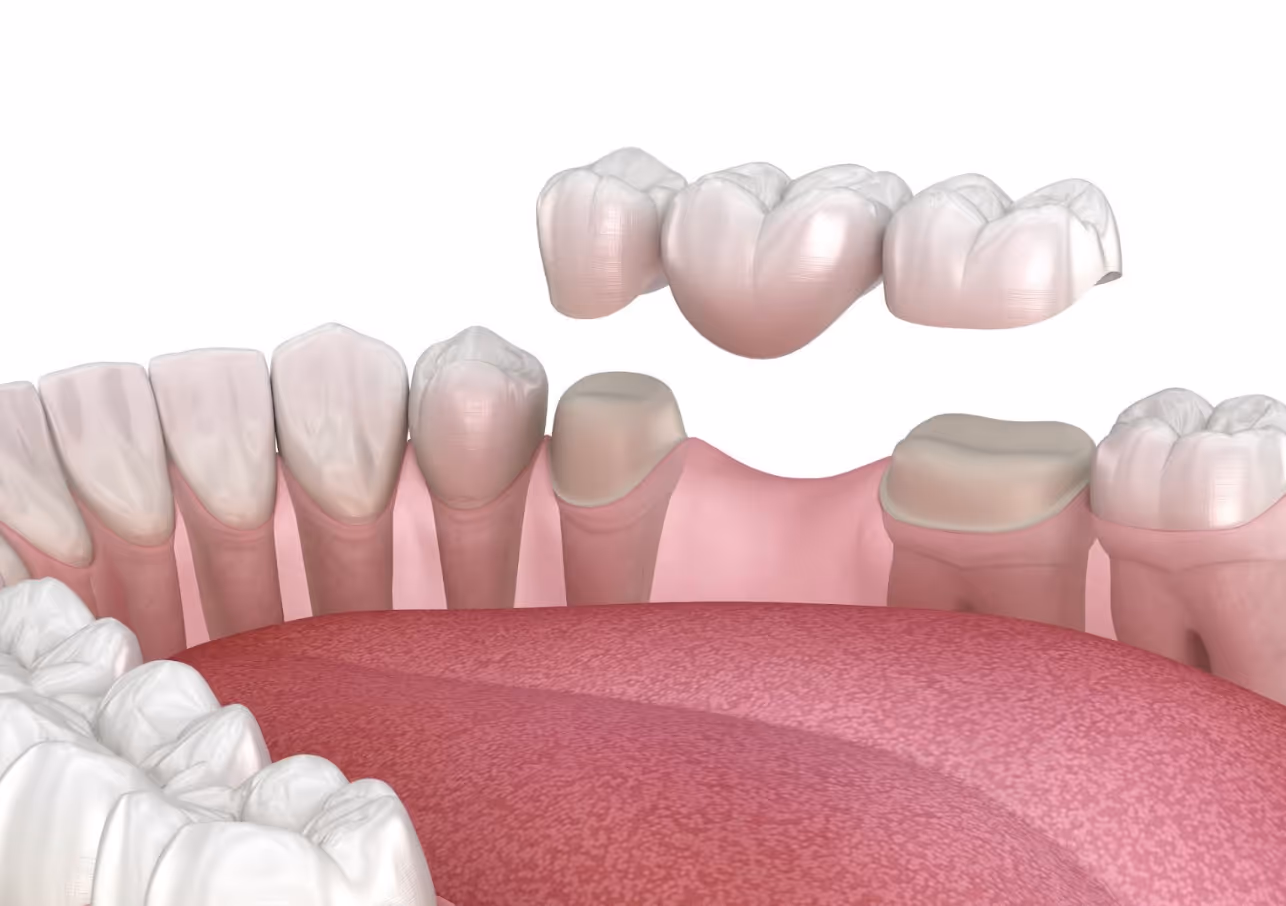 3D illustration of a dental bridge being placed over prepared teeth to replace a missing tooth