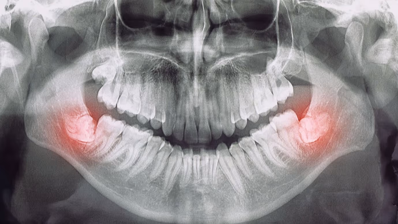 Panoramic dental X-ray highlighting inflamed or impacted areas