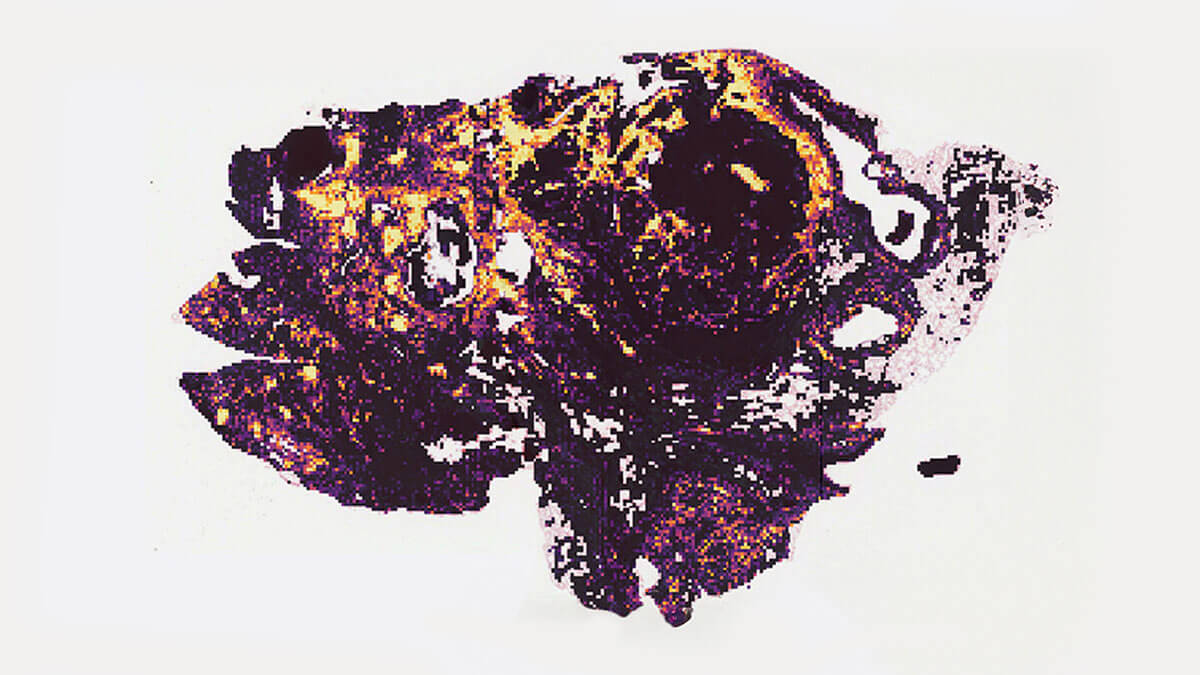 Lymphocytes - after