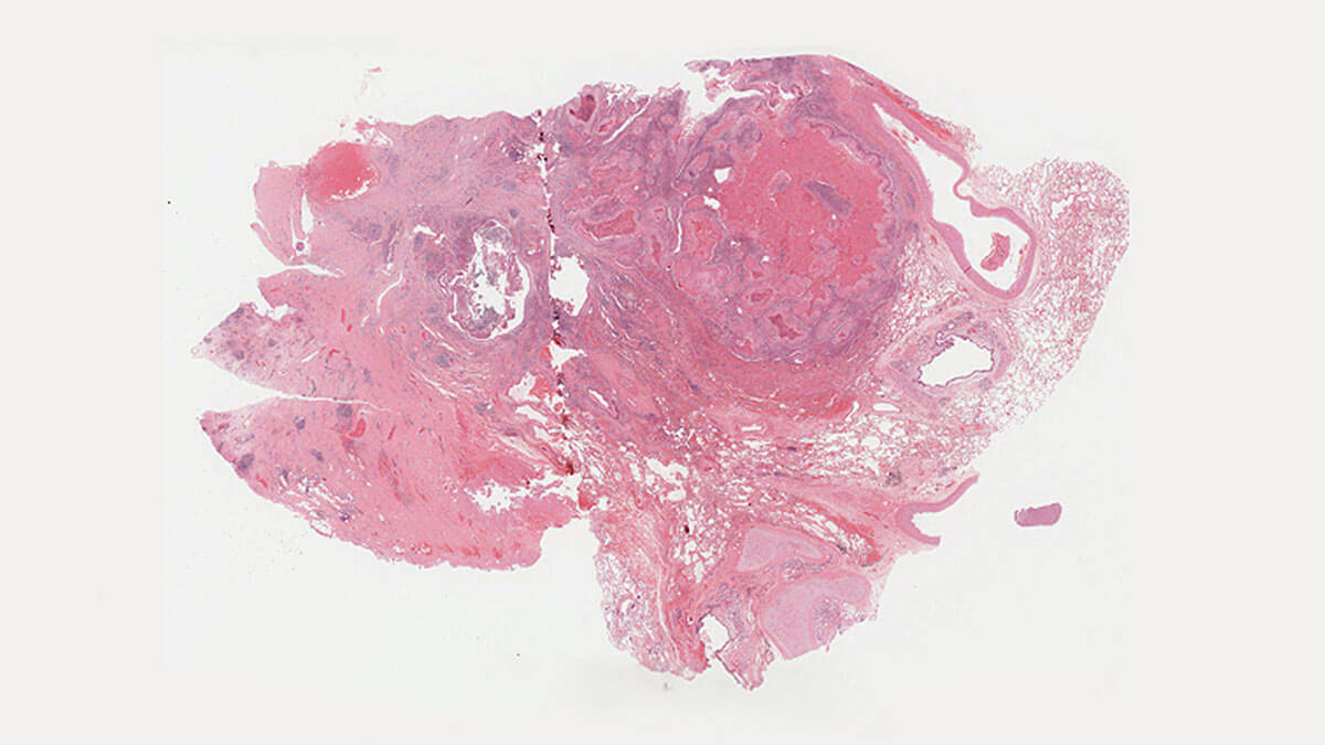 Lymphocytes