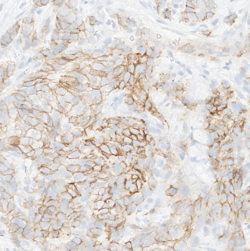 IHC slide of tumour tissue