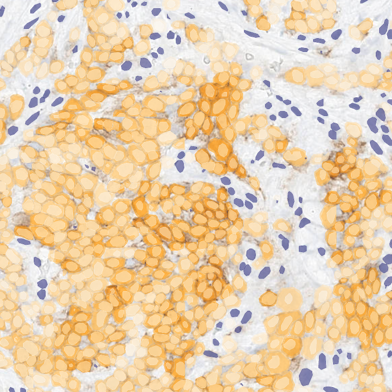 AI heatmap over the IHC slide highlighting predictive regions