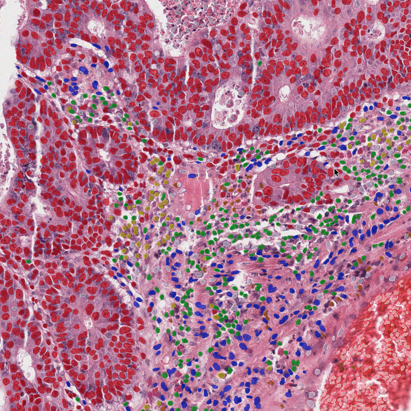 AI heatmap over the H&E slide highlighting predictive regions