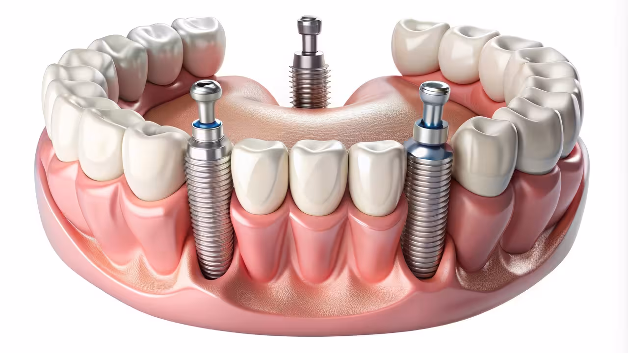 Implant-Supported Dentures