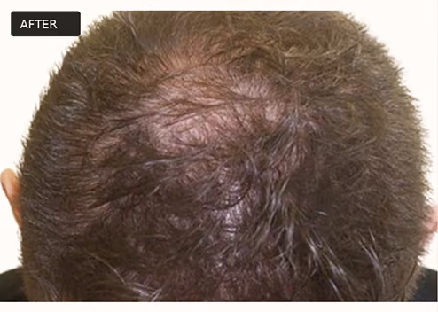 Close-up top view of a person's head showing improved hair density with less visible scalp, labeled 'AFTER' in the top left corner.